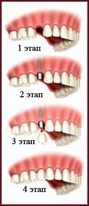 Этапы установки одиночного зубного импланта