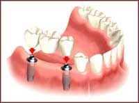 Установка моста на два зубных импланта