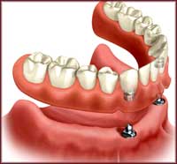 Крепление протеза на два зубных импланта